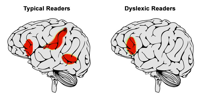 typicaldyslexia